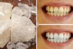 Alum For Teeth Whitening